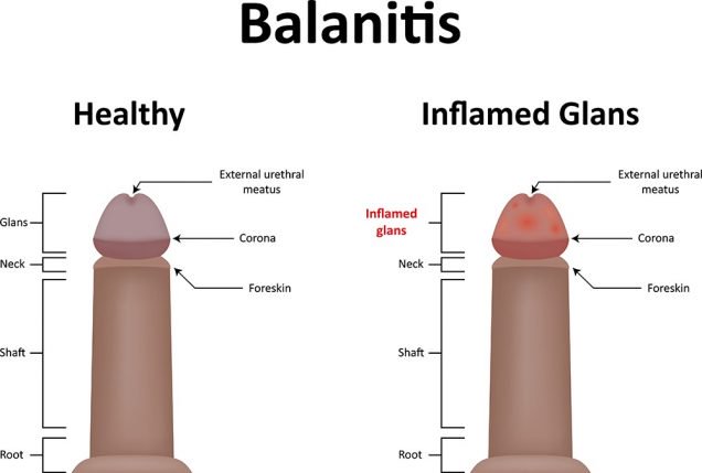 Can Balanitis be cured?