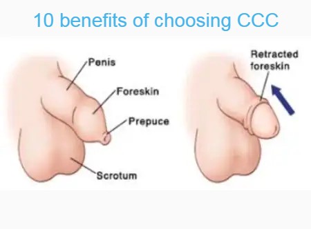 Chenani circumcision clinic