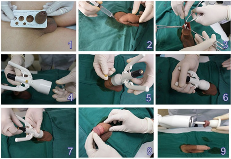 Sunnath operation at chennai