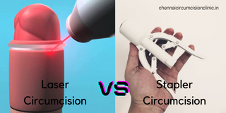laser circumcision vs stapler circumcision (1)