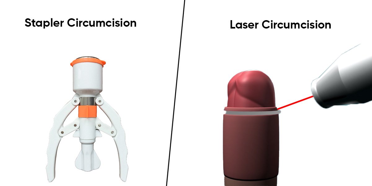 Stapler Circumcision and Laser Circumcision