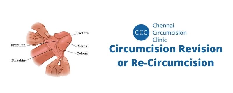 Circumcision Revision Re-Circumcision